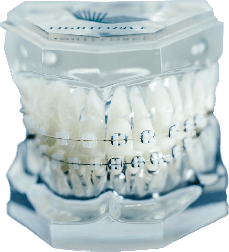 clear braces on model